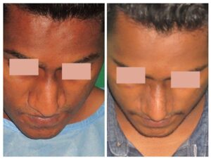Best Rhinoplasty Surgeon In India