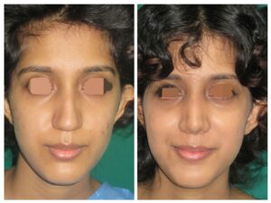 Best Rhinoplasty Surgeon In India
