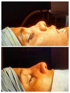 Best Rhinoplasty Surgeon In India