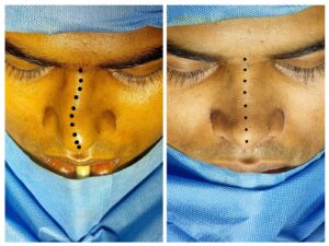Best Rhinoplasty Surgeon In India