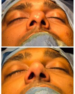 Best Rhinoplasty Surgeon In India