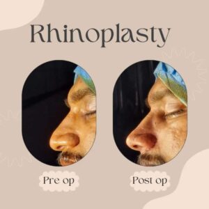 Best Rhinoplasty Surgeon In India