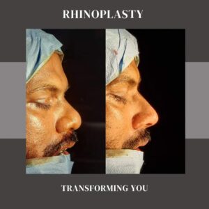 Best Rhinoplasty Surgeon In India