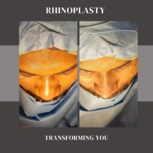 Best Rhinoplasty Surgeon In India