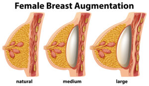breast augmentation in kerala